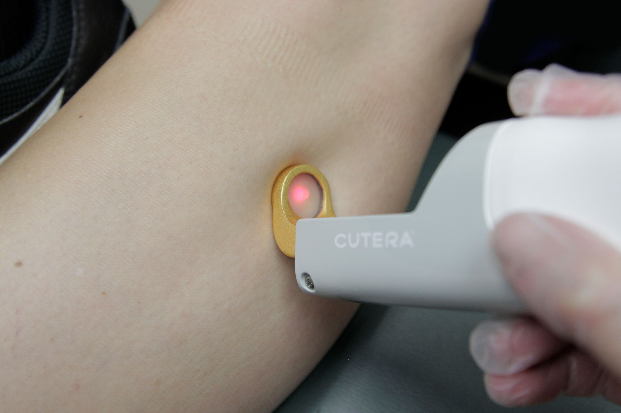 Treatment of facial vascular lesions with Cutera vascular laser - Dr. Mehrdad Timourian, skin, hair and beauty specialist