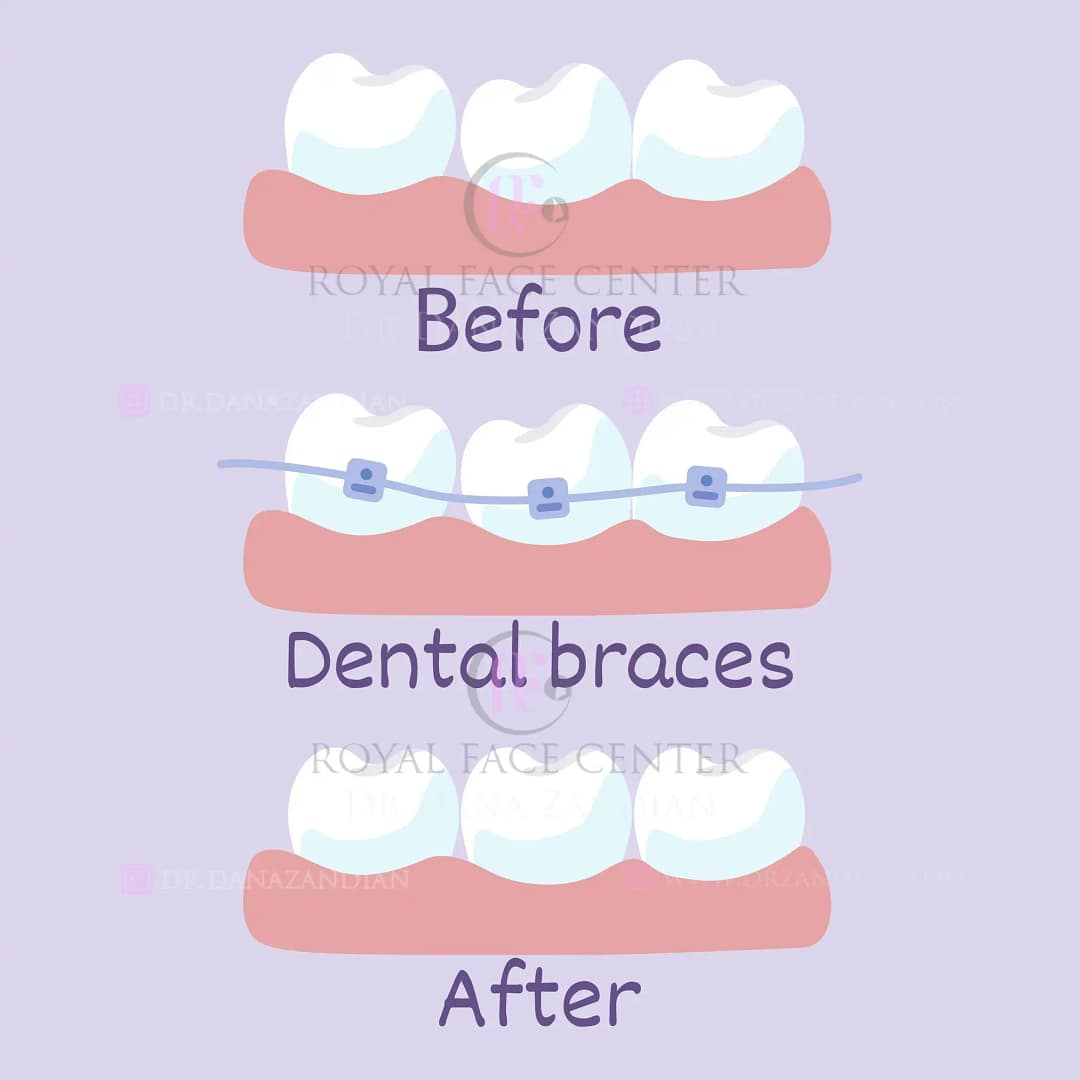 The benefits of orthodontic treatment and everything you need to know!