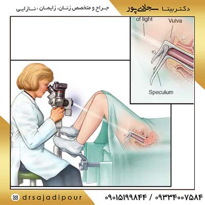 تفاوت بین پاپ اسمیر و کولپوسکوپی: یک آزمایش مهم برای تشخیص سرطان دهانه رحم