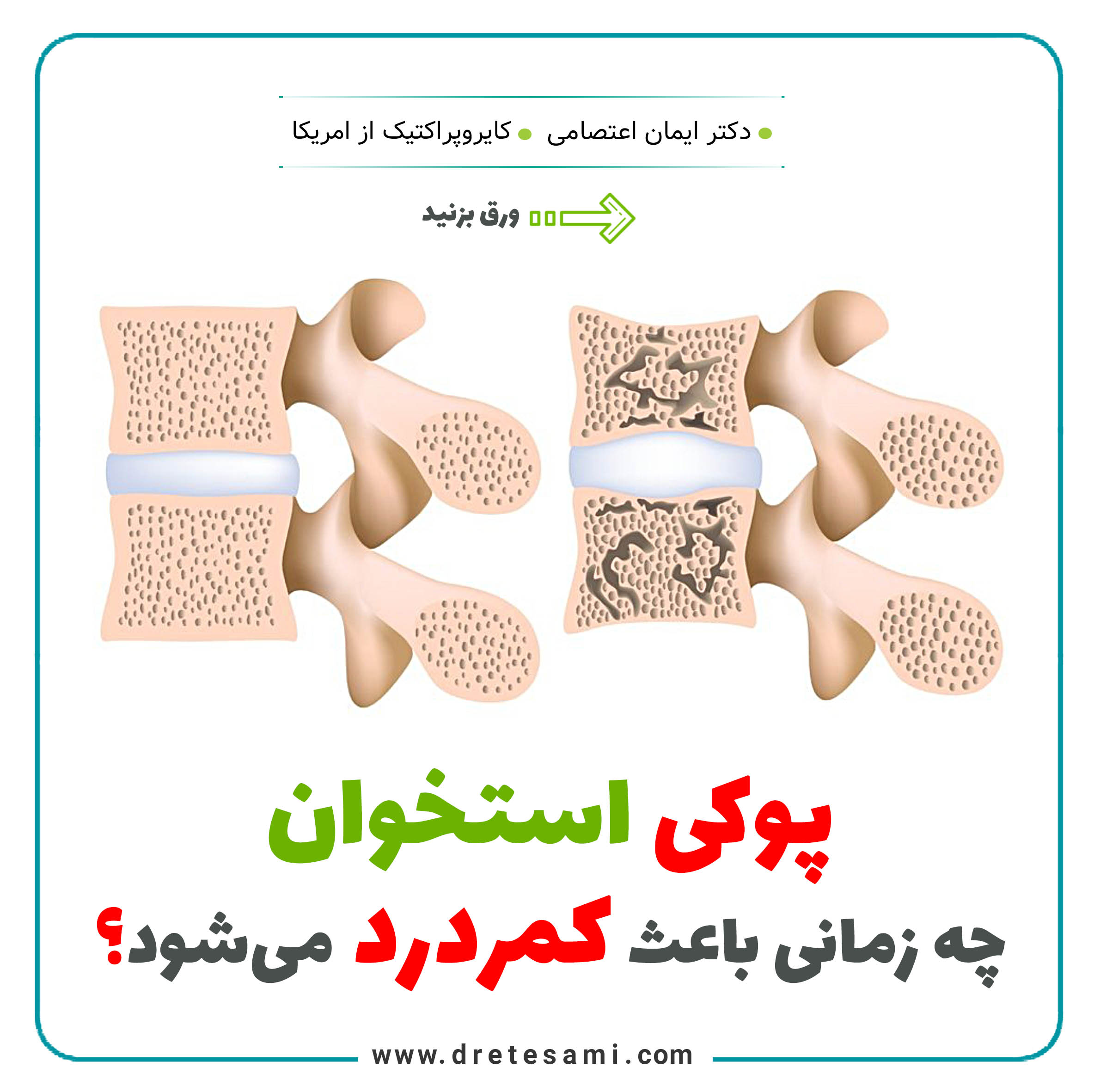 Osteoporosis and back pain