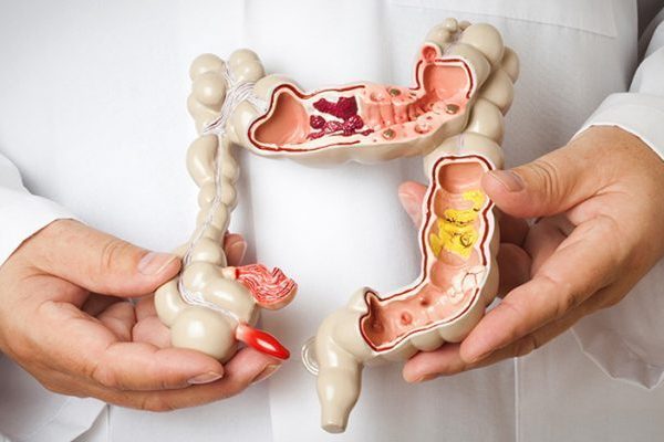 فحص سرطان القولون والمستقيم - د. كرامتي، أخصائي جراحة القولون والمستقيم