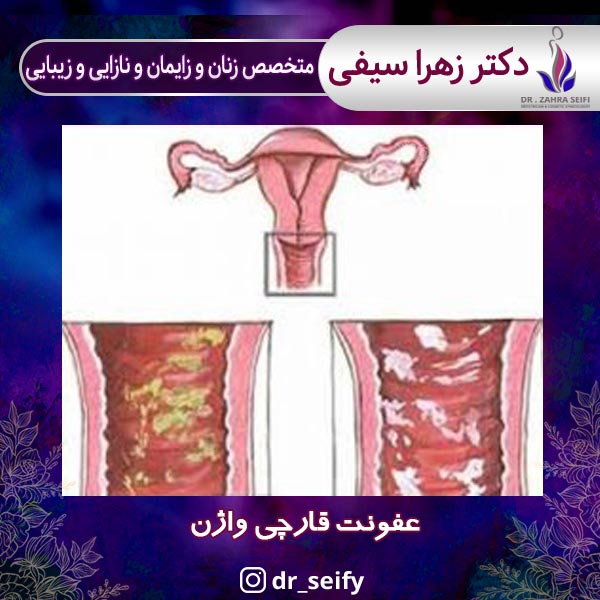 Vaginal fungal infection + Tehran gynecologist + Dr. Zahra Seifi