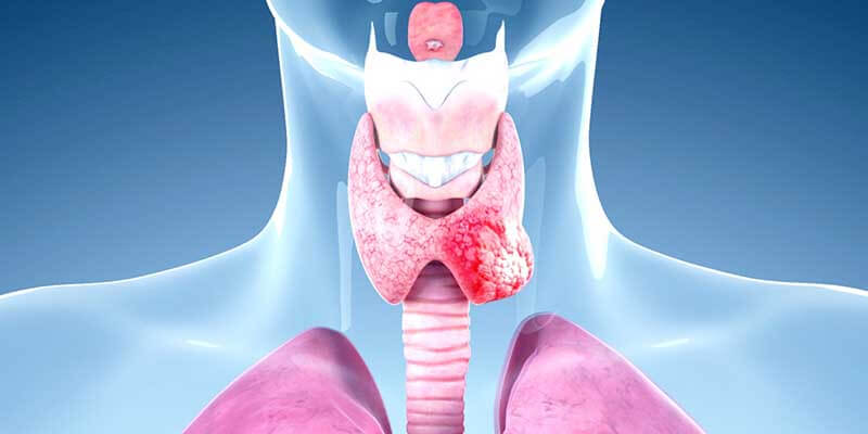 What is follicular thyroid cancer? Symptoms, diagnosis and treatment