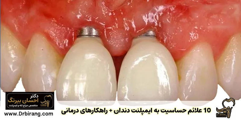 10 علامت حساسیت به ایمپلنت دندان + راهکارهای درمانی - دکتر احسان بیرنگ