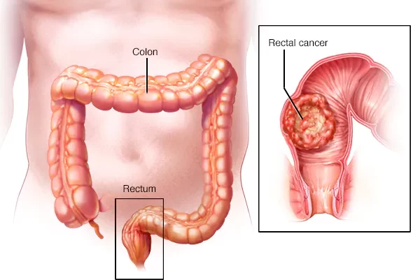 سرطان المستقيم - الدكتور كرامتي أخصائي جراحة القولون والمستقيم