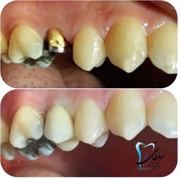 روکش سرامیک مولر کوچک دکتر جمال سلطانی جراح دندانپزشک و متخصص ایمپلنت در تبریز
