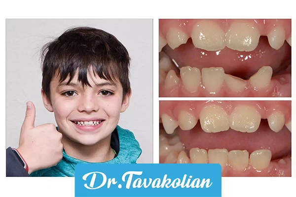 باندینگ دندان کودکان - دکتر توکلیان