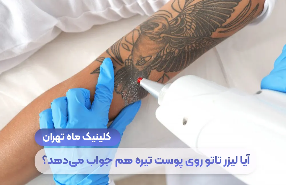هل يعمل الوشم بالليزر على البشرة الداكنة؟ - عيادة طهران ماه