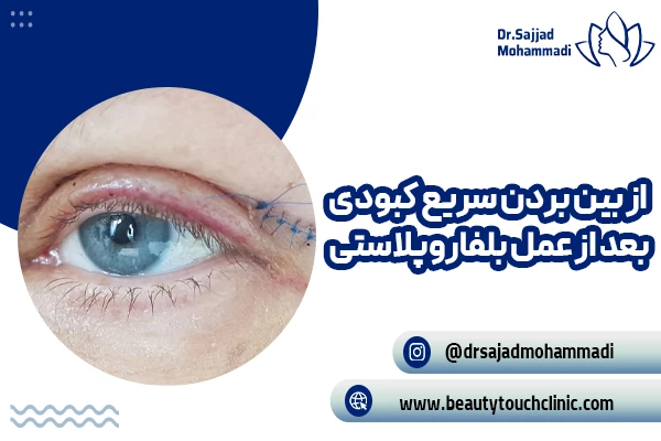 رفع سریع کبودی بعد از بلفاروپلاستی