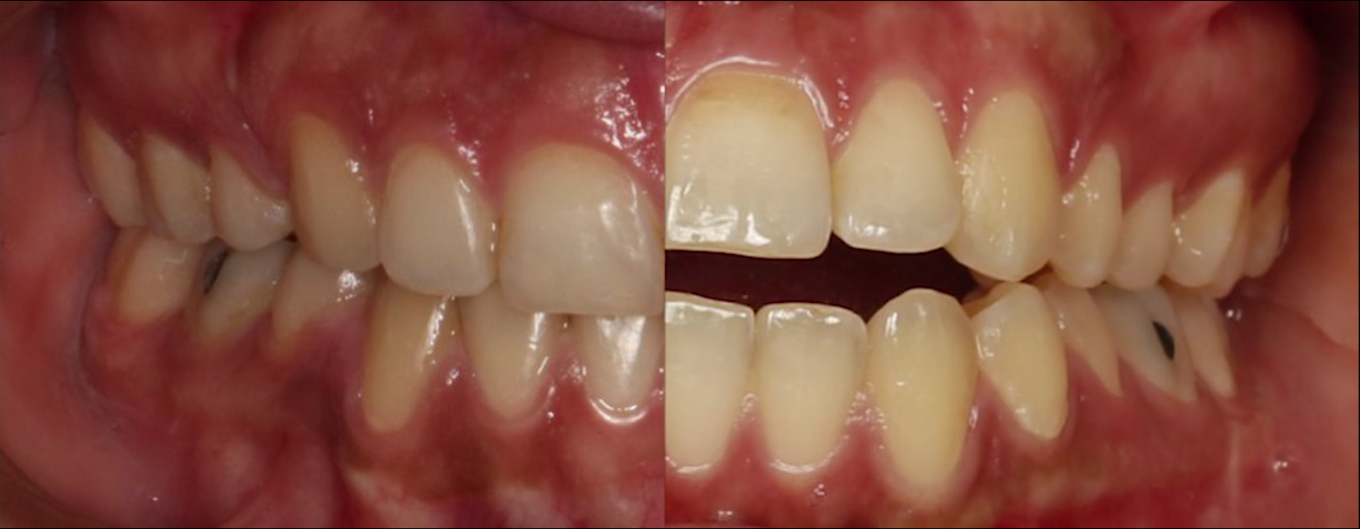 Fixed orthodontics and before and after treatment-1- (video) - Dr. Dana Zandian - Orthodontic specialist in Ahvaz
