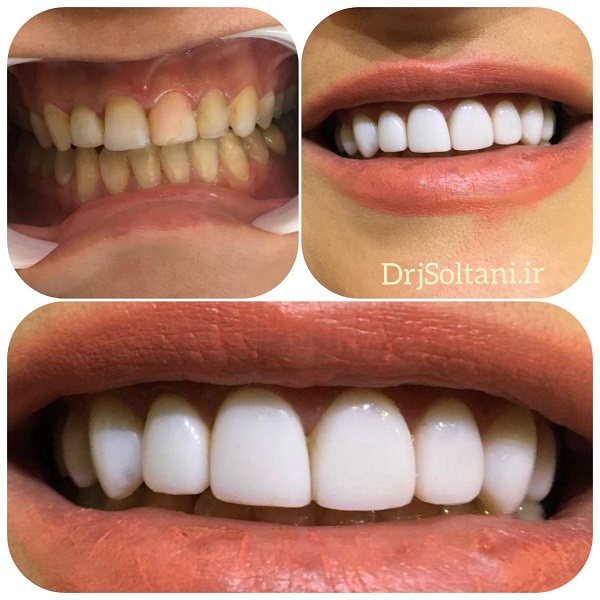 10 یونیت لمینت کامپوزیت فک بالا دکتر جمال سلطانی جراح دندانپزشک و متخصص ایمپلنت در تبریز