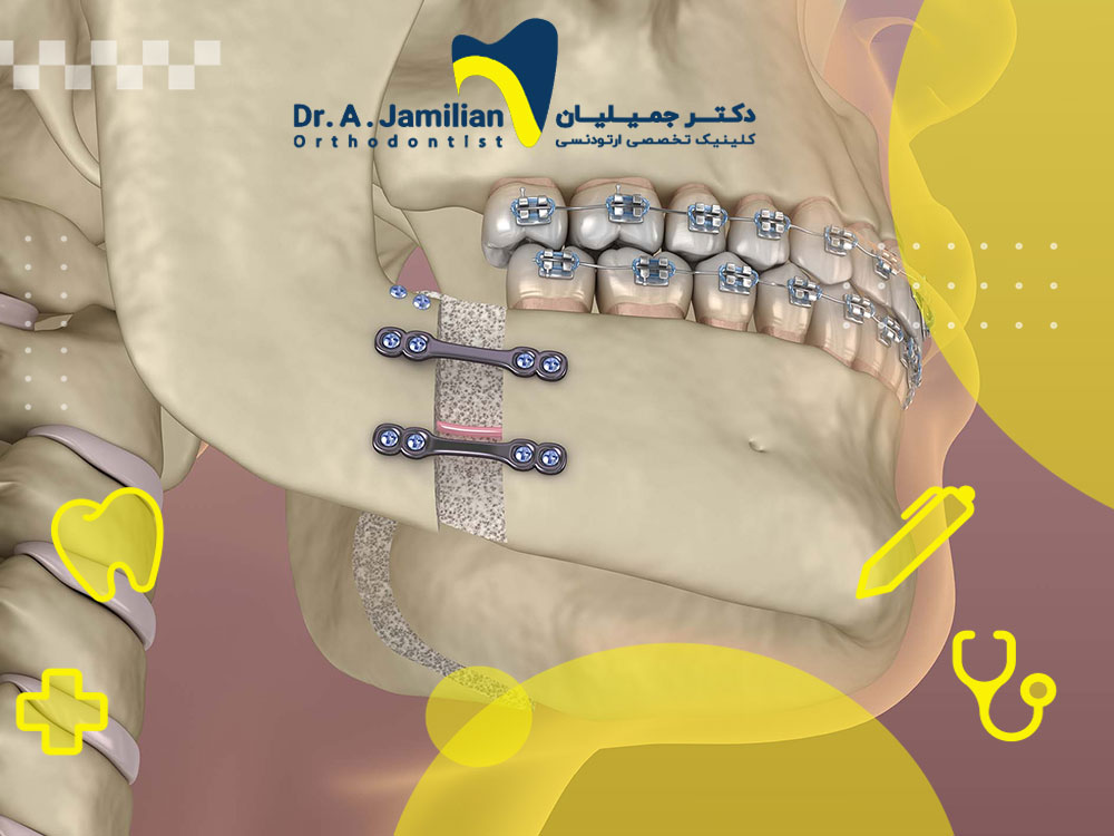 When is jaw surgery necessary for orthodontics? - Dr. Jamilian