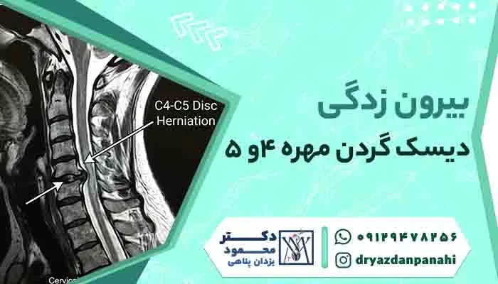 Protrusion of the 4th and 5th cervical disc Symptoms, treatment and cause