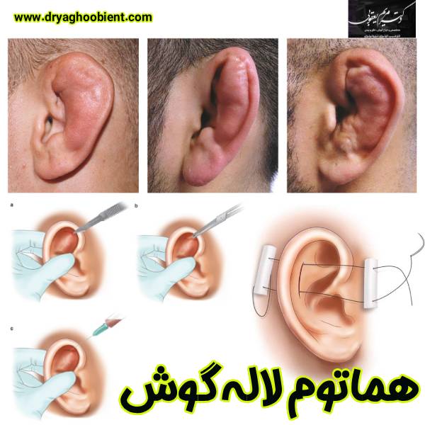 Ear lobe hematoma (cauliflower ear). Causes and preventions