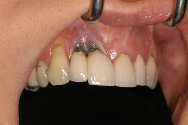 loss of sense of taste after dental implant; Reasons and ways of treatment
