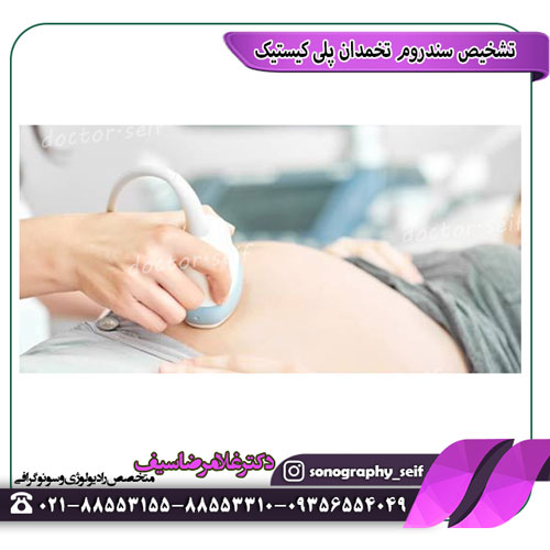 تشخیص سندرم تخمدان پلی کیستیک