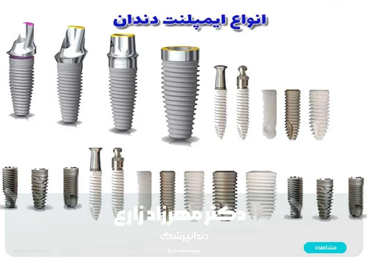 Types of dental implants: which one is better?