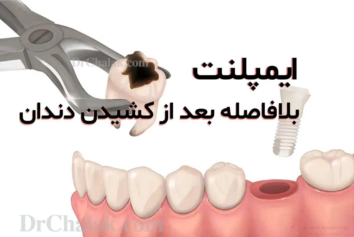 ایمپلنت دندان بلافاصله بعد از کشیدن دندان (ایمپلنت فوری) - دکتر چالاک 🦷❤