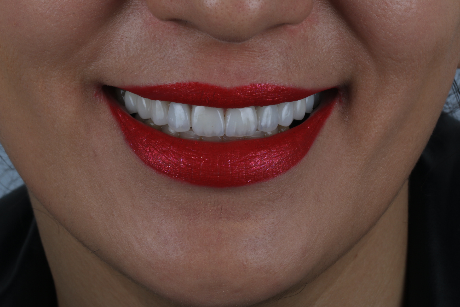 صفائح الأسنان في سعدات آباد - استشارة مجانية اليوم!