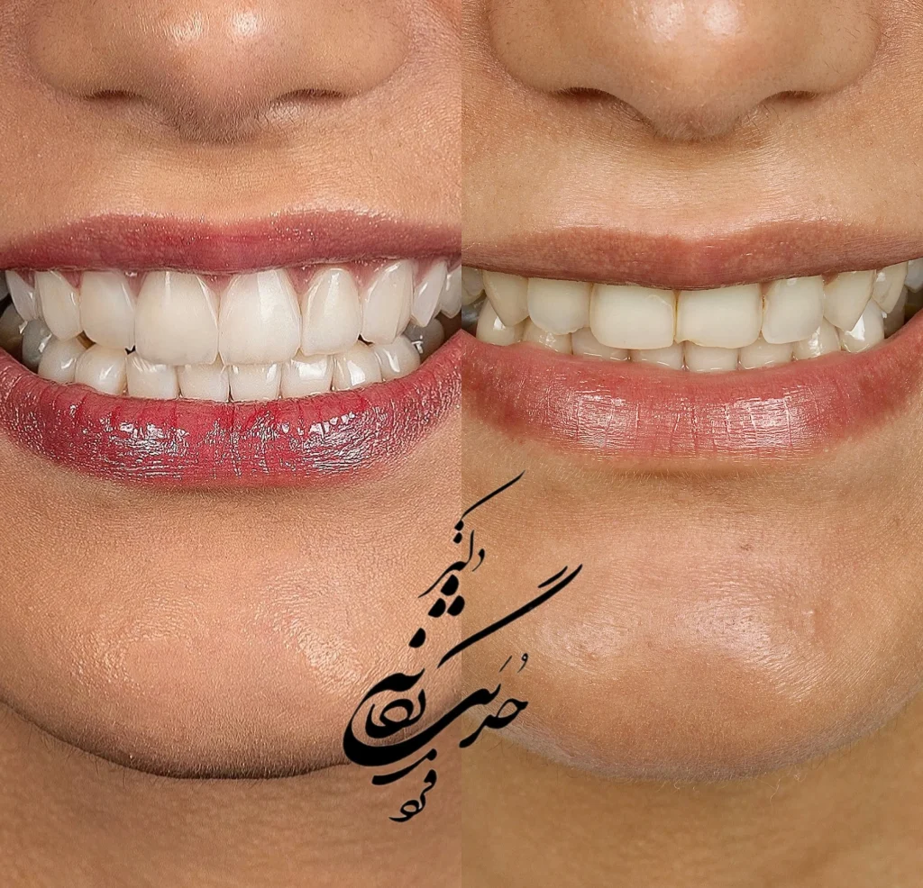 پله های کامپوزیت دندان در تهران 1404 دکتر حدیث یگانه فرد