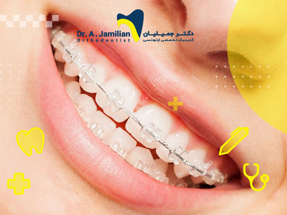 Why is ceramic orthodontics a popular choice for adults? - Dr. Jamilian