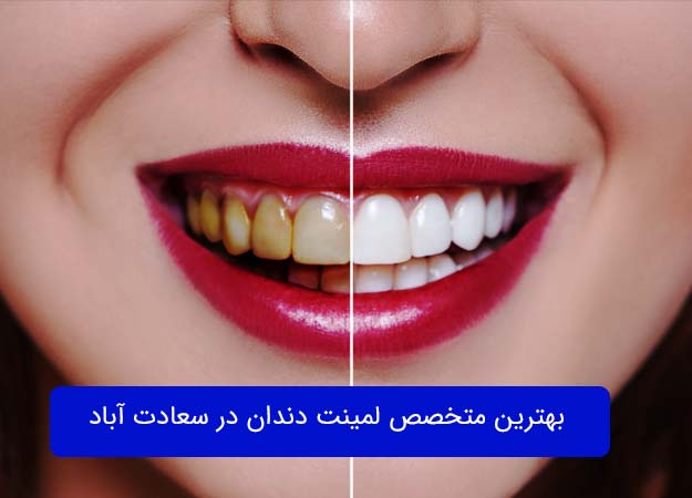 Dental laminate in Saadat Abad