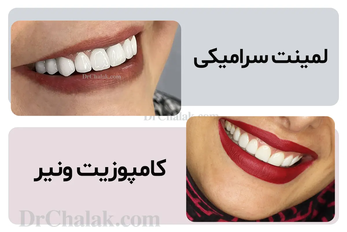 هل اللامينيت أفضل أم المركب؟ الفرق بين صفائح الأسنان ومركب الأسنان 🦷❤