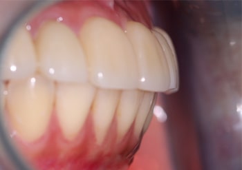 teeth coming forward after composite; Dentist's mistake or dental form?
