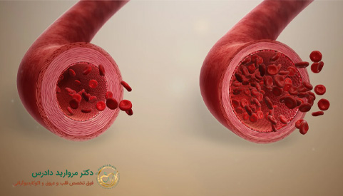 كل شيء عن توسع القلب. من التشخيص إلى الوقاية - د. مارفاريد دادريس