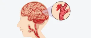 What is a stroke? Symptoms of stroke in women, men and young people