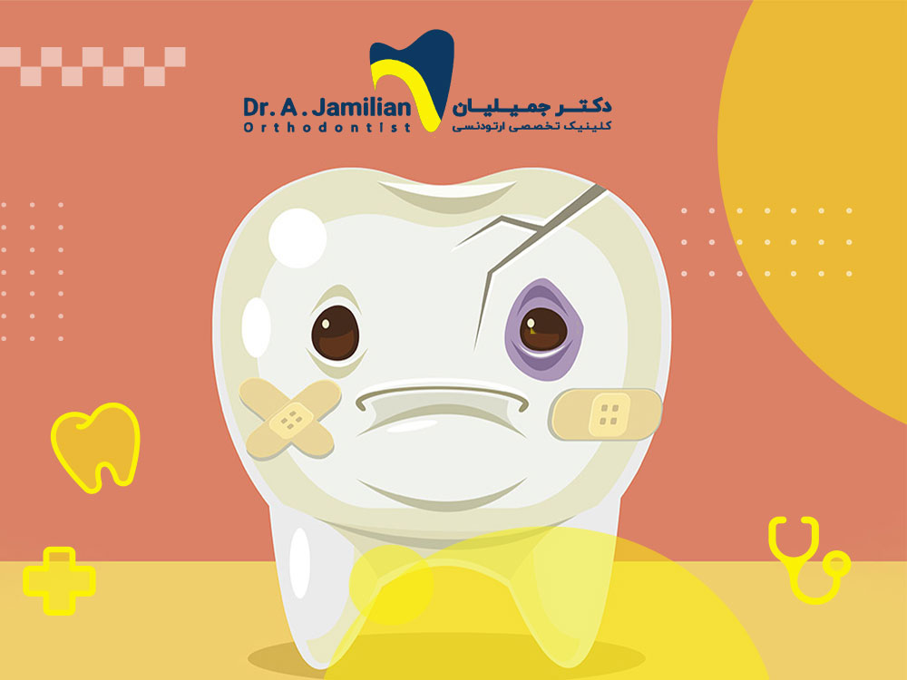 Tooth wear, symptoms, complications and treatment methods - Dr. Jamilian