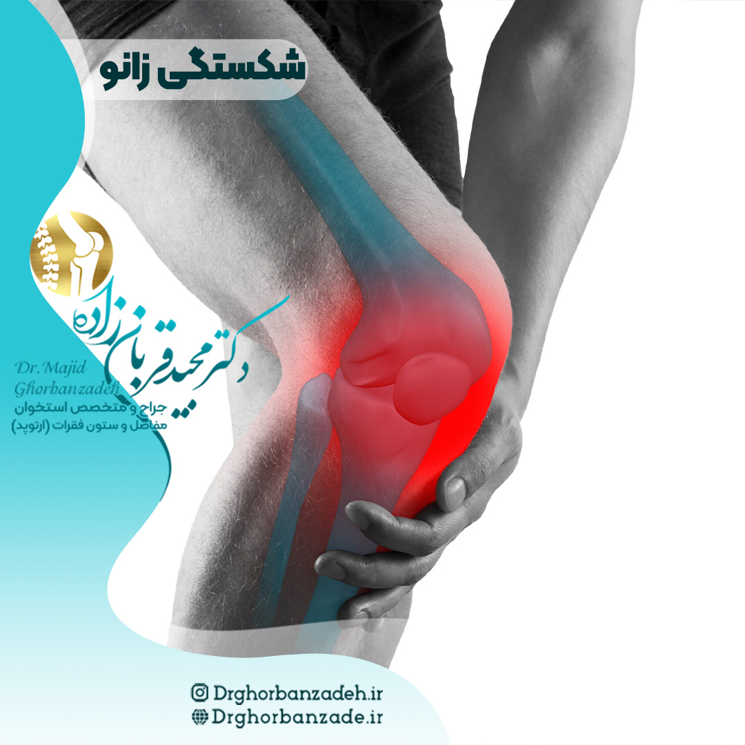 شکستگی مفصل زانو - علائم و درمان آن دکتر مجید قربان زاده