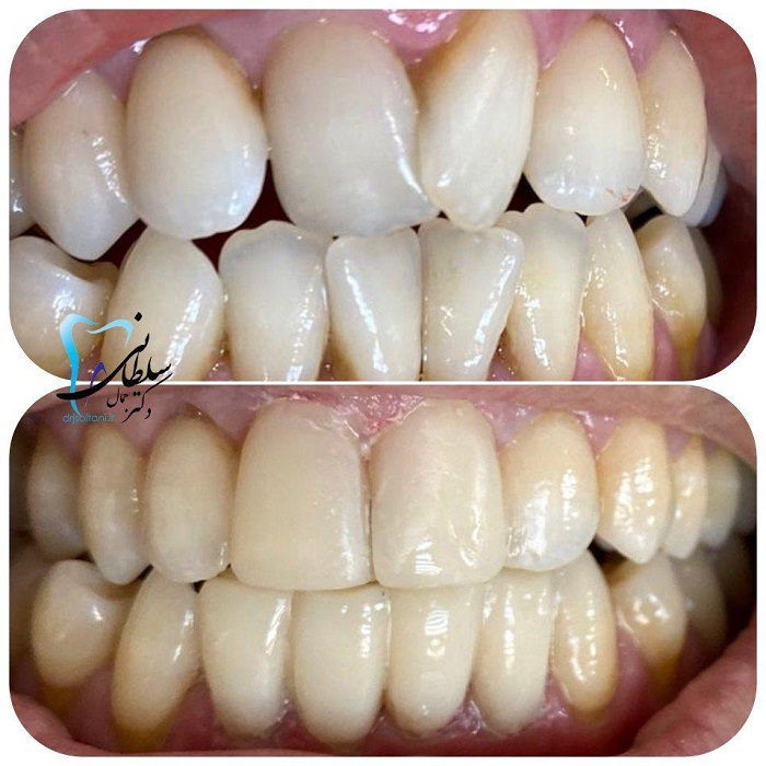 لمینت کامپوزیت دکتر جمال سلطانی جراح دندانپزشک و متخصص ایمپلنت در تبریز