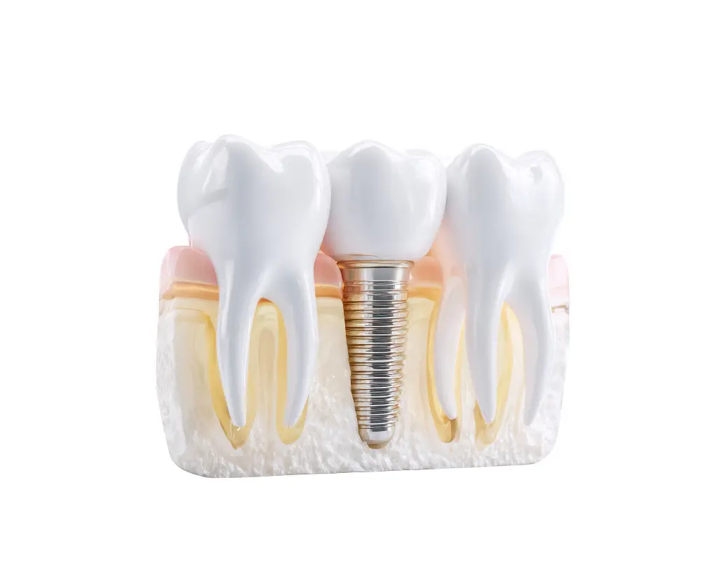 آسیب به ایمپلنت دندان علل، علائم و راه حل های متخصص