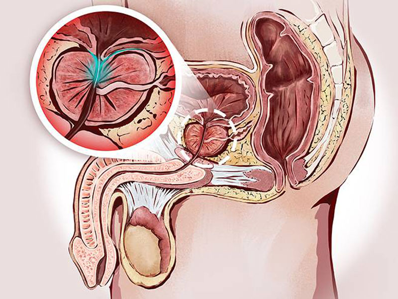 BPH versus prostate cancer - Jahanshahr Urology Center