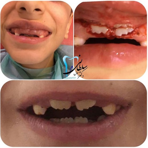 لیزر بافت ضخیم دکتر جمال سلطانی جراح دندانپزشک و متخصص ایمپلنت در تبریز