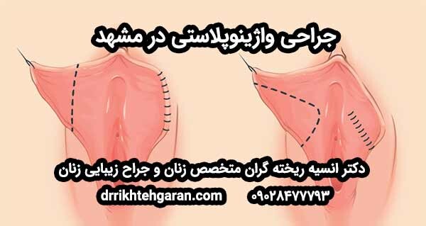 جراحی واژینوپلاستی در مشهد; راهنمای کامل + تجربه تخصصی دکتر انسیه روزگاران