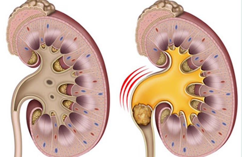 Types of kidney stones - Jahanshahr Urology Center