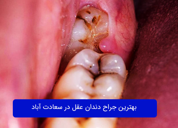 Wisdom tooth surgery in Saadat Abad