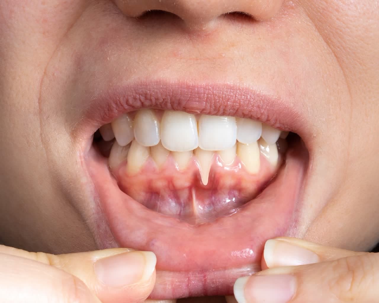 طرق الوقاية من التهاب اللثة في الشيخوخة - طب الأسنان للدكتور بهاري سيباهريان