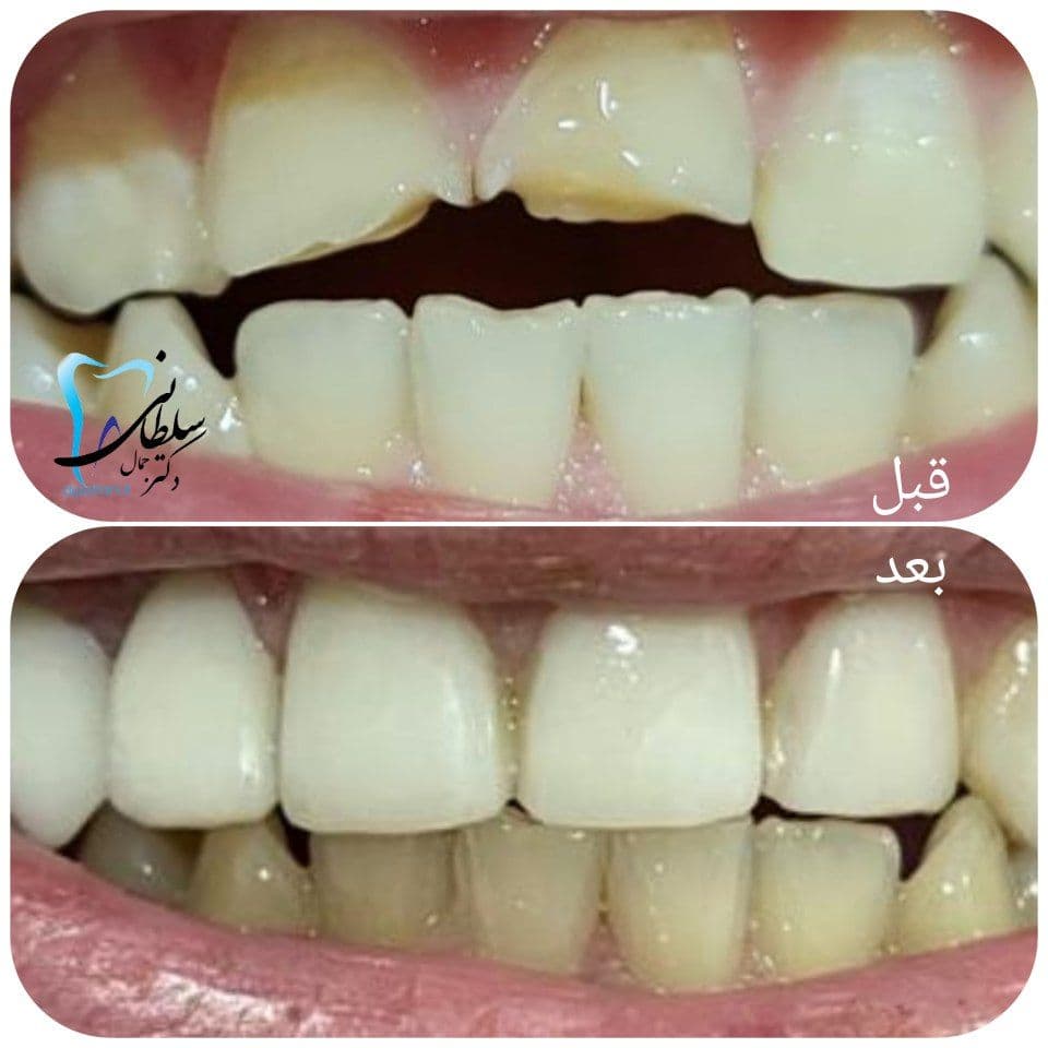 نمونه کار ترمیمی در کلینیک دندانپزشکی دکتر جمال سلطانی تبریز دکتر جمال سلطانی جراح دندانپزشک و متخصص ایمپلنت در تبریز