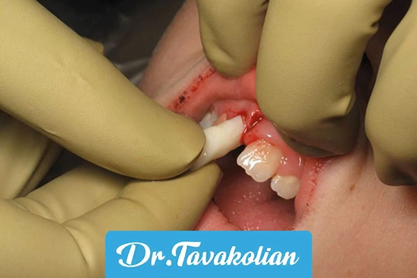 ضربه به دندان شیری کودکان - دکتر توکلیان