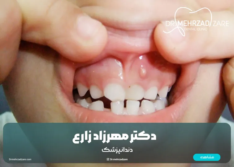 Gum cysts in children