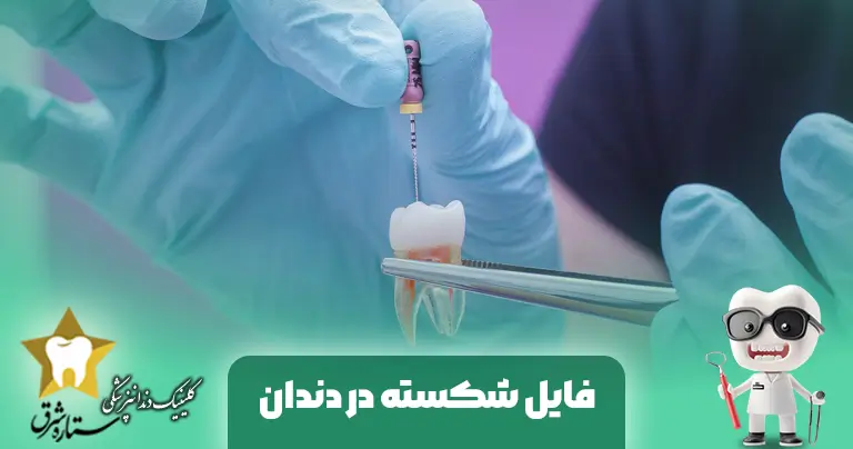 فایل شکسته در دندان: علت، عوارض و جدیدترین روش های درمانی