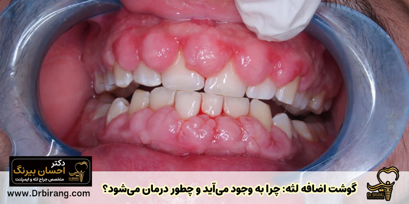 بافت اضافی لثه: چرا ایجاد می شود و چگونه درمان می شود؟ - دکتر احسان بیرنگ