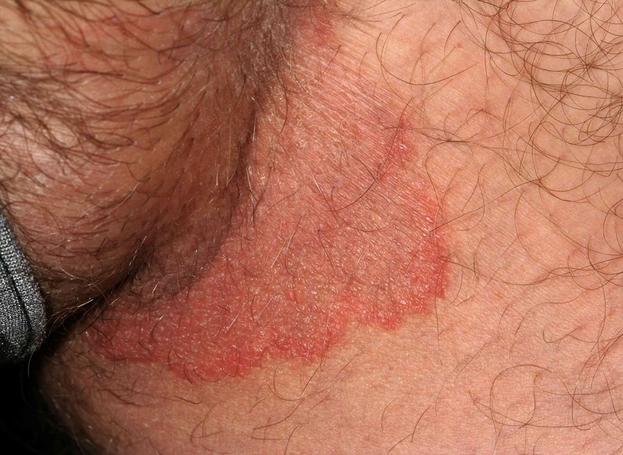 درمان سریع عفونت تناسلی مردان - مرکز اورولوژی جهانشهر