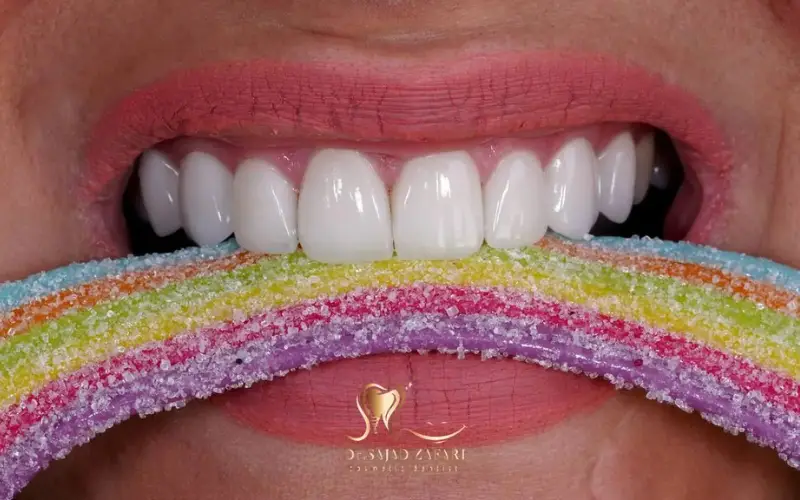 لمینت دندان خرگوش همه چیز در مورد روش ها و مراقبت