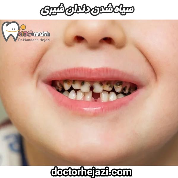 What is the cause of black milk teeth? Treatment and ways to prevent Dr. Mandana Hejazi