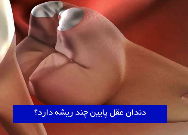 ضرس العقل السفلي له عدة جذور