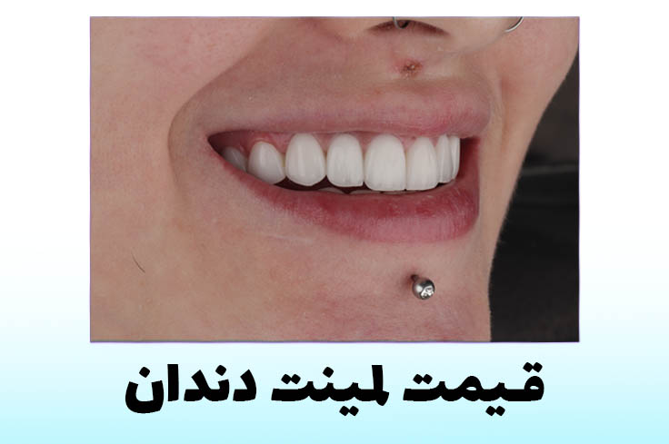 قیمت لمینت دندان 1404 | هزینه لمینت دندان طرح لبخند